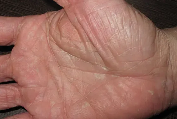 Seasonal Shedding or Disease? Exfoliative Keratolysis - My, The medicine, Disease, Disease history, Body check, Longpost, Doctors, Problem skin, Leather, Dermatology, Kvd, Treatment, Genetic diseases