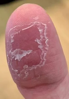 Seasonal Shedding or Disease? Exfoliative Keratolysis - My, The medicine, Disease, Disease history, Body check, Longpost, Doctors, Problem skin, Leather, Dermatology, Kvd, Treatment, Genetic diseases