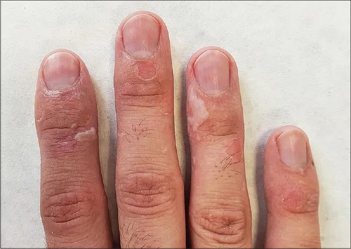 Seasonal Shedding or Disease? Exfoliative Keratolysis - My, The medicine, Disease, Disease history, Body check, Longpost, Doctors, Problem skin, Leather, Dermatology, Kvd, Treatment, Genetic diseases