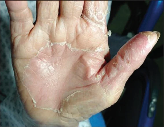 Seasonal Shedding or Disease? Exfoliative Keratolysis - My, The medicine, Disease, Disease history, Body check, Longpost, Doctors, Problem skin, Leather, Dermatology, Kvd, Treatment, Genetic diseases