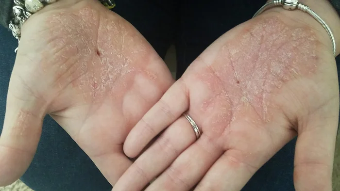 Seasonal Shedding or Disease? Exfoliative Keratolysis - My, The medicine, Disease, Disease history, Body check, Longpost, Doctors, Problem skin, Leather, Dermatology, Kvd, Treatment, Genetic diseases