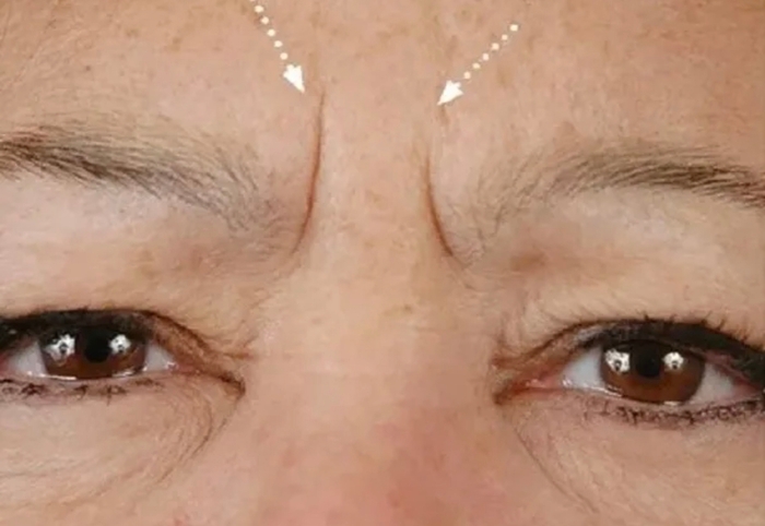 Морщины, ботекс, депрессия