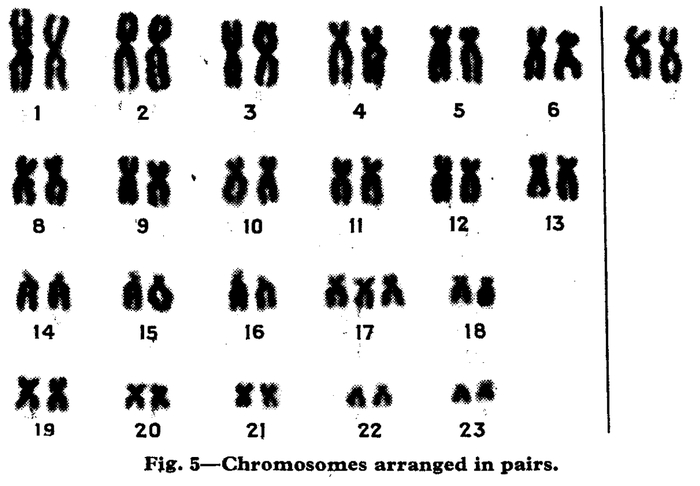 Иллюстрация кариотипа больной девочки из первой публикации Джона Эдвардса. Лишняя хромосома по ошибке опрделена 17, а не 18