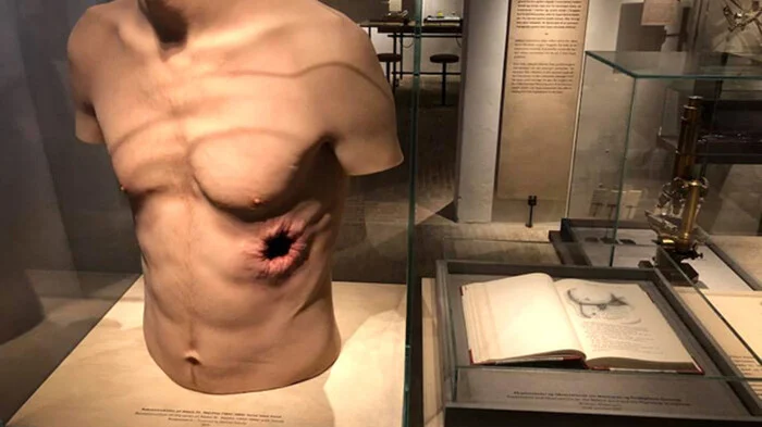 Человек который жил с дырой в животе Прошлое, Опыт, Необычное, Медицина, Длиннопост Человек который жил с дырой в животе Прошлое, Опыт, Необычное, Медицина, Длиннопост