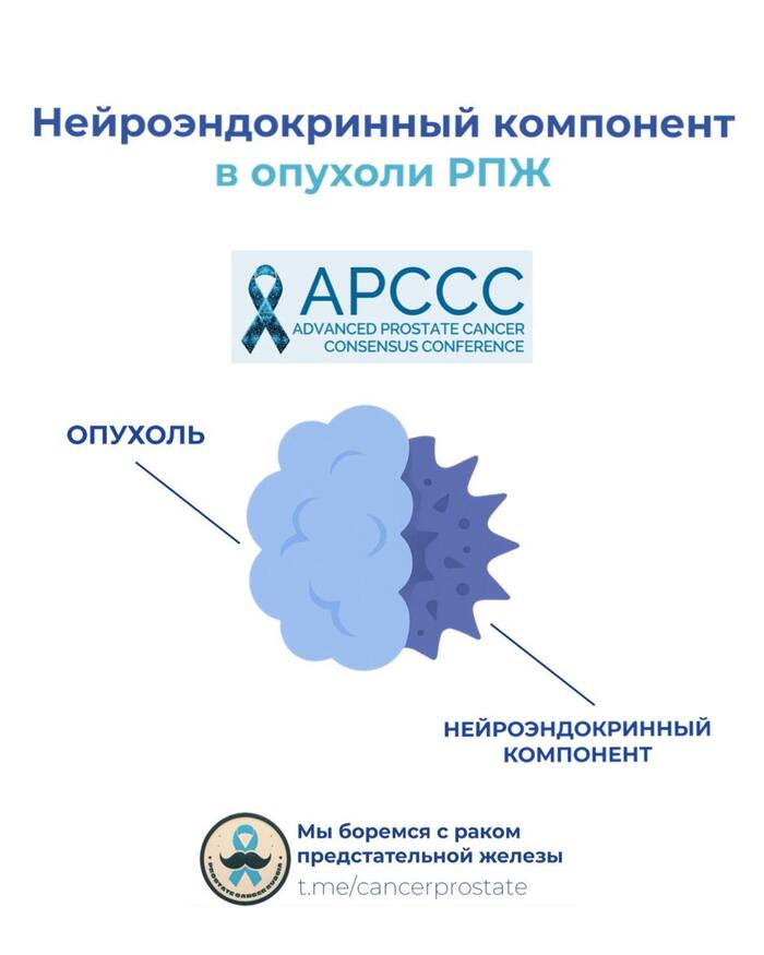 Нейроэндокринный компонент в опухоли рака предстательной железы