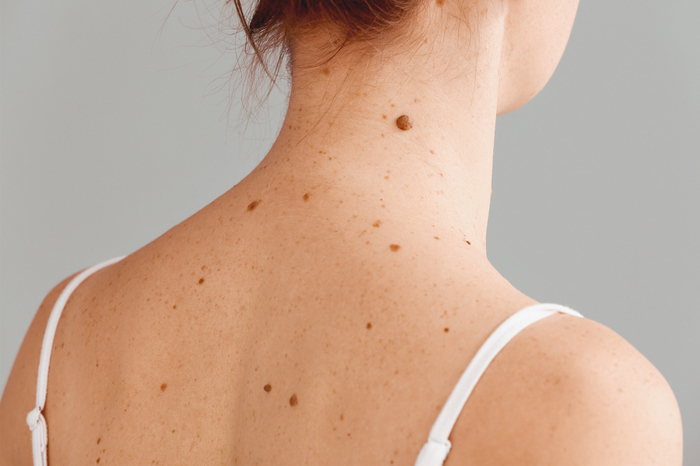 Если у тебя больше 100 родинок, у тебя рак!