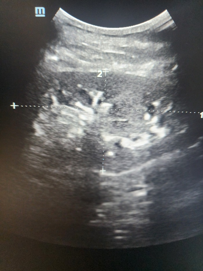 Продолжение истории про 60000МЕ витамина Д в сутки