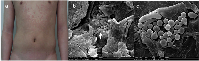(рис. b) Множественные гифы (Н) среди чешуек эпидермиса. (рис. с) Почкующиеся дрожжи (S) и гифы (Н)