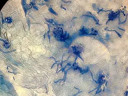 Fungal Spots - Versicolor Lichen - My, Problem skin, Dermatology, Fungus, The medicine, Medications, Stains, Longpost