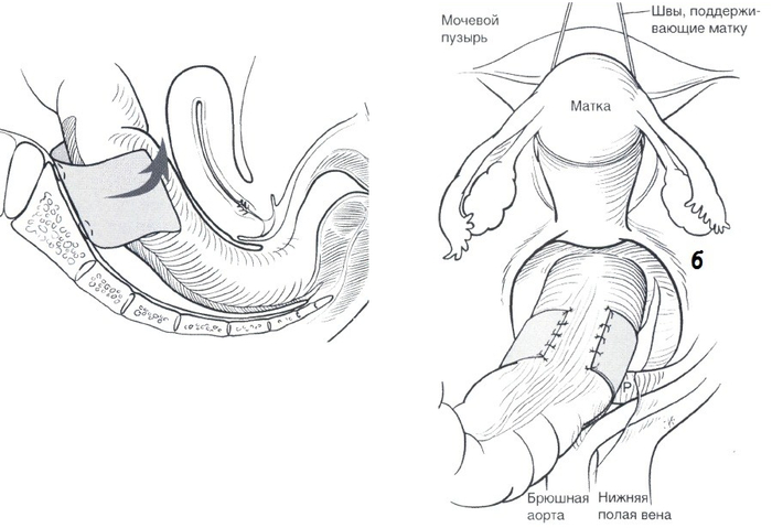 Один из вариантов - специальная сетка фиксируется к крестцу и обнимает кишку, не давая ей опускаться и формировать ректоцеле