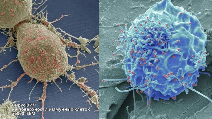 Лимфоцит заражённый ВИЧ