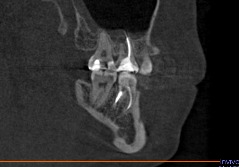 Проблемный зуб.