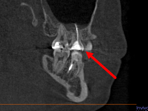 Проблемный зуб, материал уходит за пределы зуба.