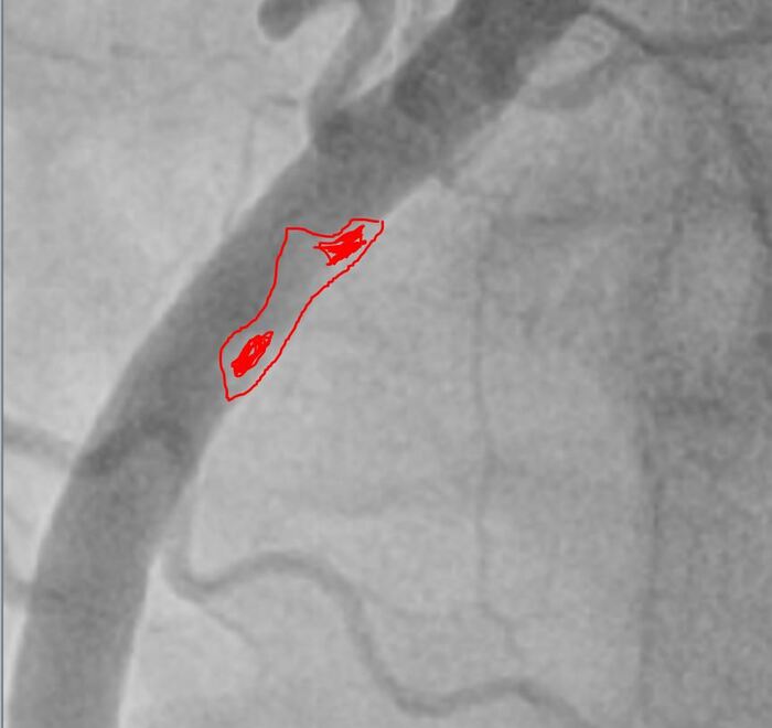 Красным зона пристеночного тромбоза, он неоднороден по плотности, рыхлый и отсюда мигрировали тромбы вниз, закупорив дистальные ветви -> как итог инфаркт.