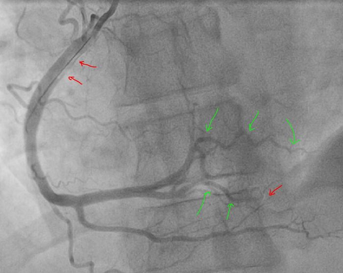 Зеленым то что восстановлено, красным остаточный тромбоз
