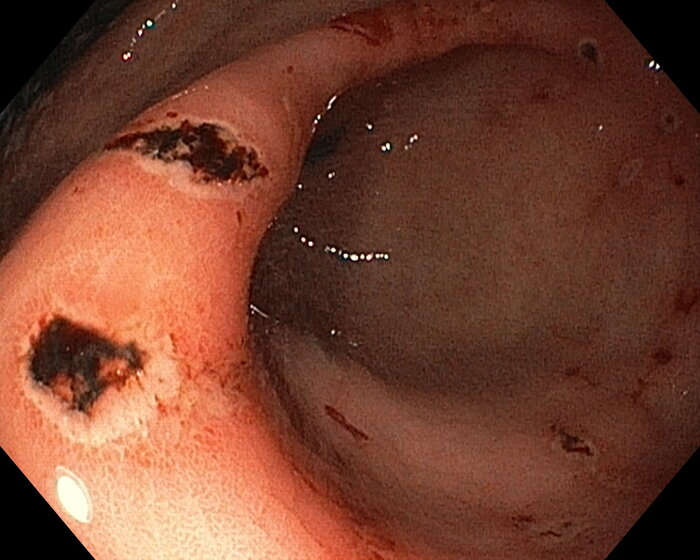 Место выхода из желудка в двенадцатиперстную кишку