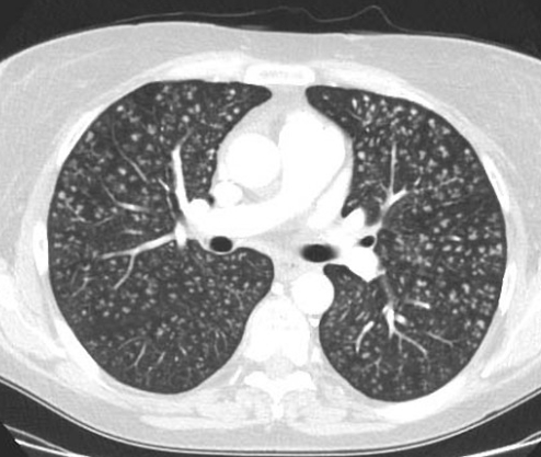 Очаговая диссеминация в легких на КТ