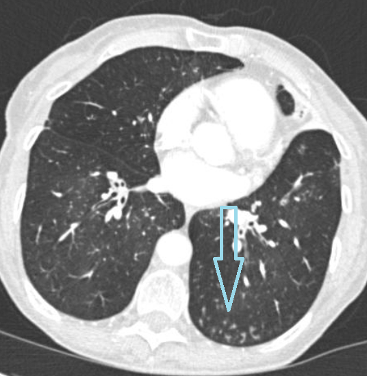 Немногочисленные центрилобулярные очаги в нижней доле левого легкого на КТ