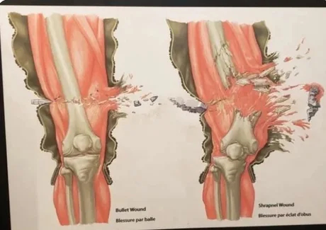 Разница между пулевым и осколочным ранением