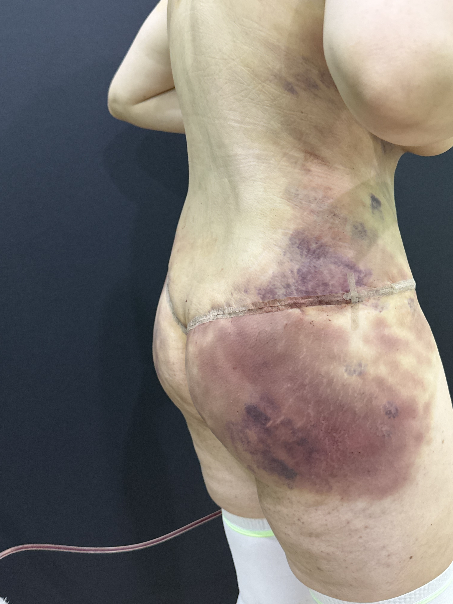 Her hourglass waist is unbreakable... - My, Childbirth, Body, Operation, Video, Vertical video, Short videos, Longpost, 18+, NSFW