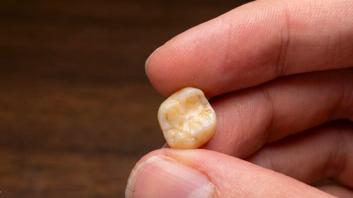 Во время еды слетела коронка с зуба. Что обязательно нужно сделать пациенту в первый час после выпадения (до визита к стоматологу)