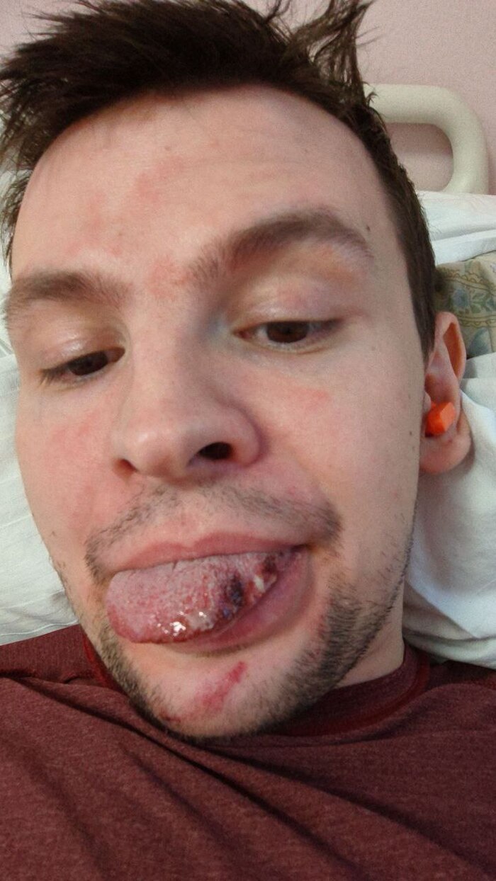в этот раз можно заметить синяк на подбородке,заживало дольше, плюсом зубная боль тоже была