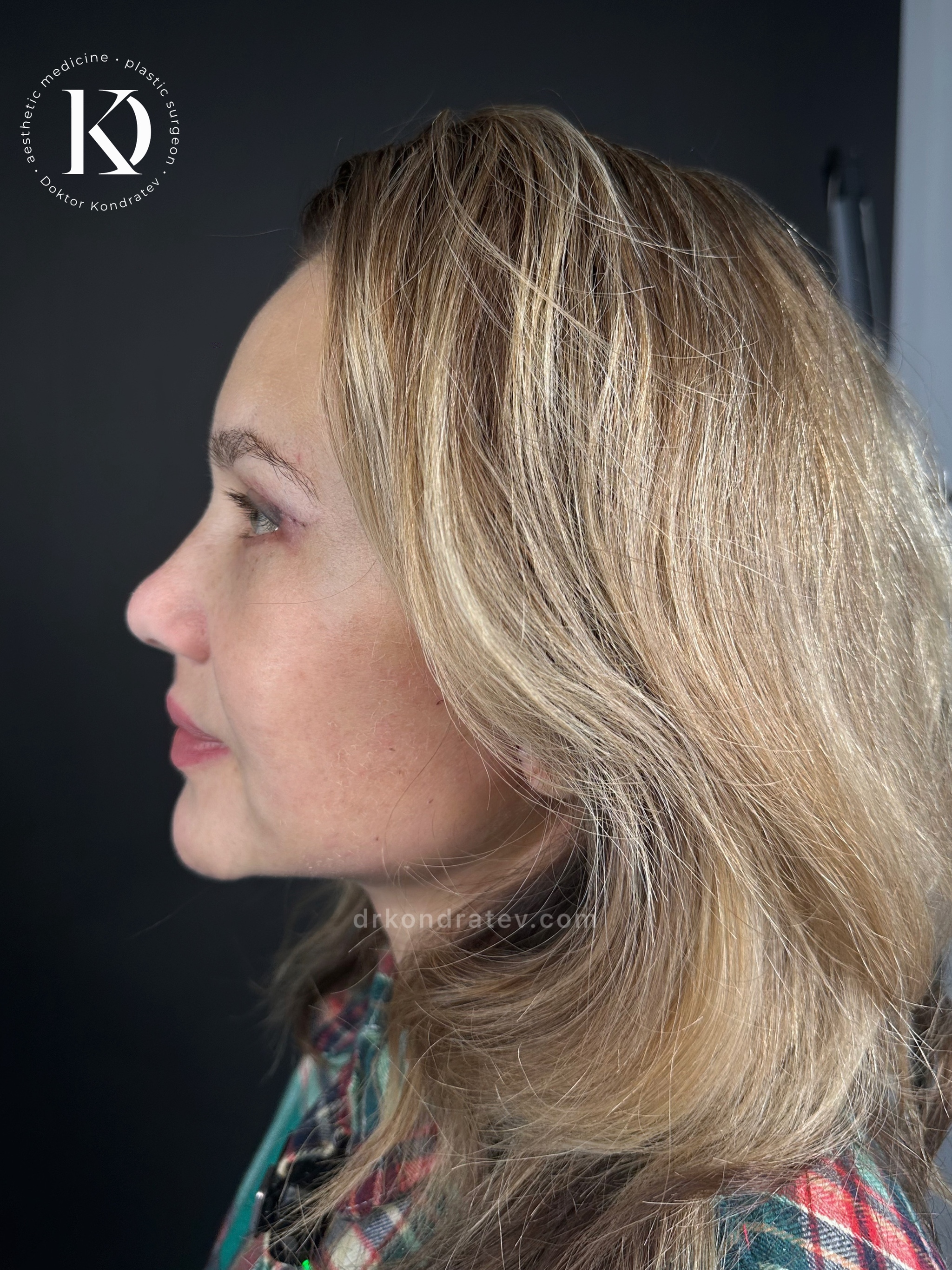 How to restore your original face without signs of overtightening? - My, Face, Facelift, Blepharoplasty, Video, Vertical video, Short videos, Longpost
