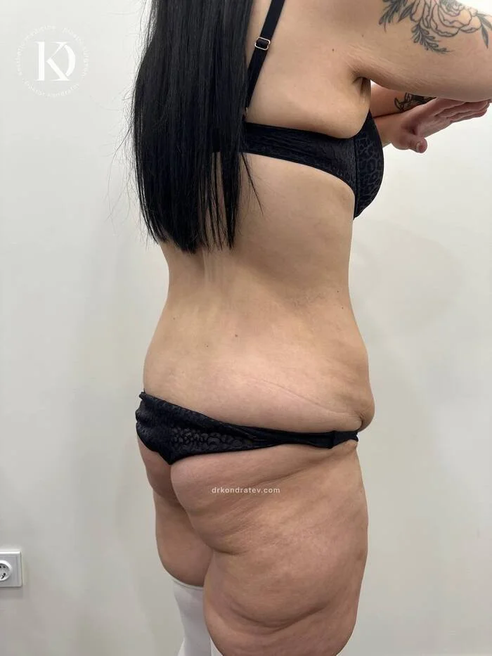 Body Correction After Massive Weight Loss, Part 2 - My, Redheads, Video, Vertical video, Longpost, Booty