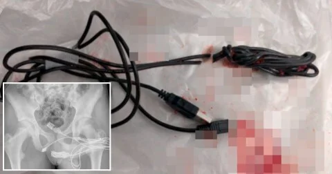 Do you want to do it like in the UK? Don't do it. - Surgery, Operation, Sexual preoccupation, Penis, 49 and 5, London, Dangerous games, news