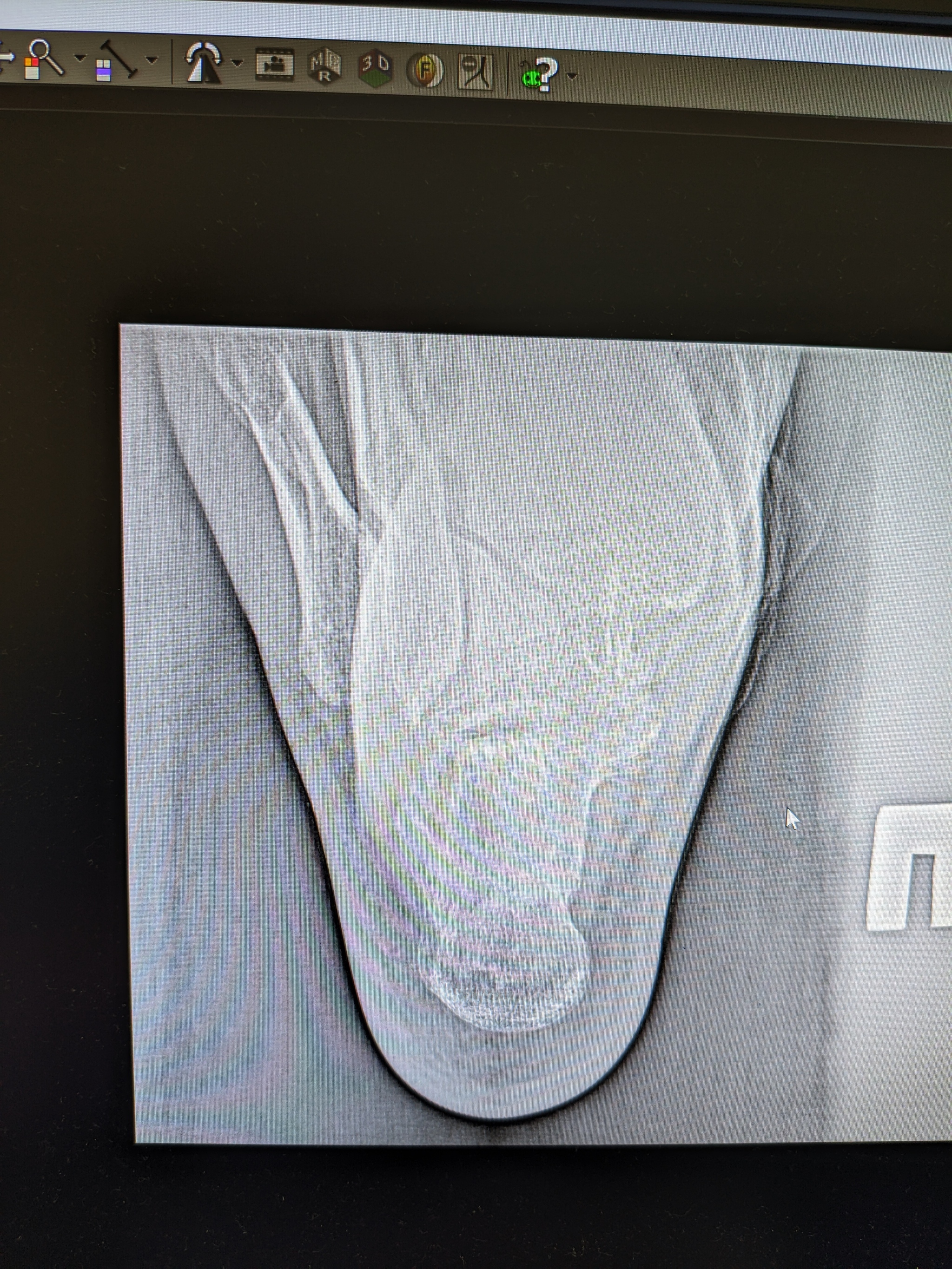 Please help me with an x-ray, I have a displaced heel fracture. - My, Orthopedics, Traumatology, Surgery, Longpost, Doctors need help
