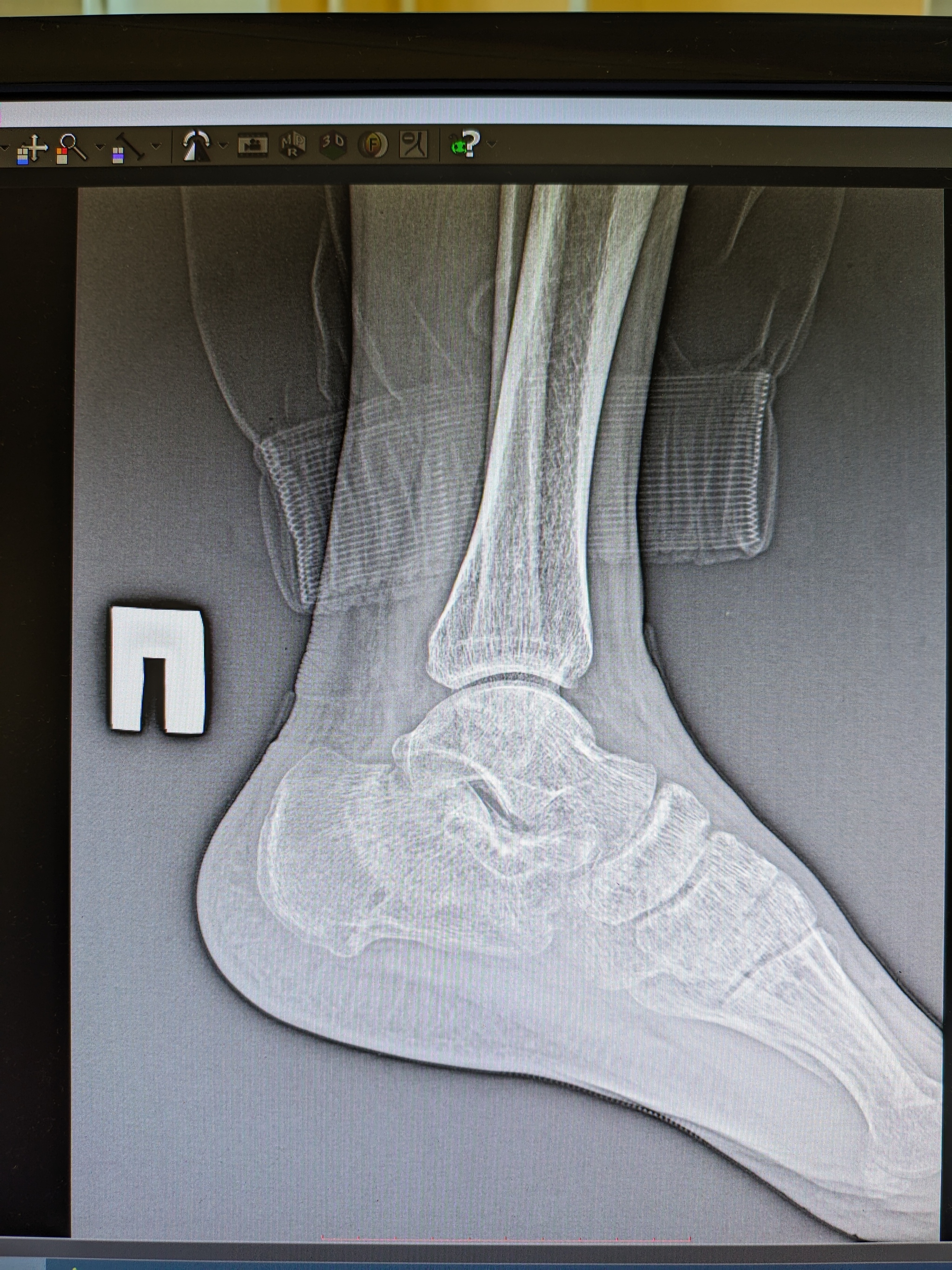 Please help me with an x-ray, I have a displaced heel fracture. - My, Orthopedics, Traumatology, Surgery, Longpost, Doctors need help