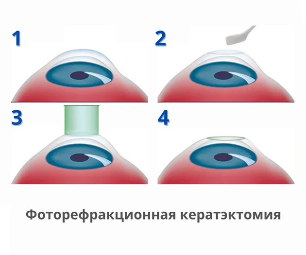 Re-correction of vision using PRK after LASIK - My, LASIK, Laser correction, Frk, Operation, Longpost