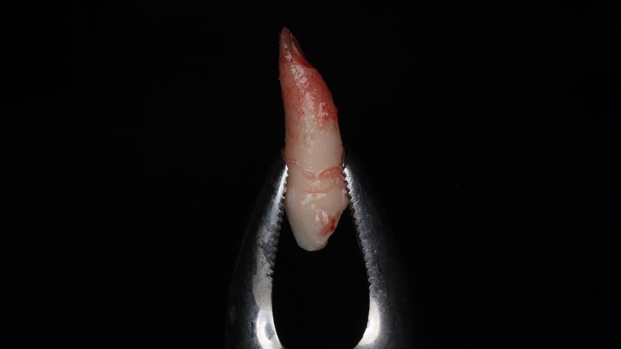 An 8-year-old female patient was referred by a colleague from St. Petersburg. - Dentistry, Teeth, Doctors, Health