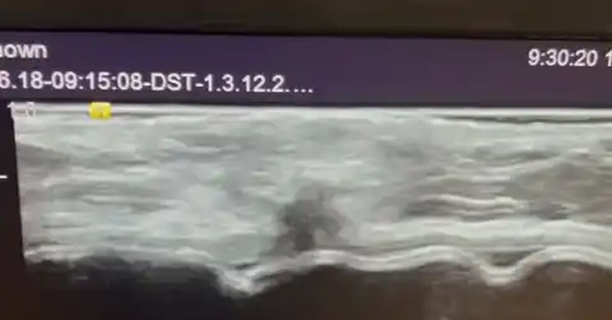 Breast cancer in patients after augmentation with implants - My, The medicine, Health, Cancer and oncology, Doctors, Medications, Link, Short videos, Video