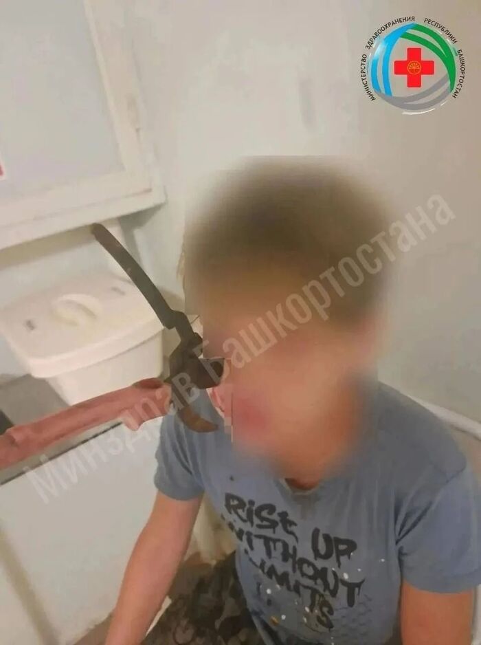 Башкирские врачи спасли подростка, которому в щеку впился секатор