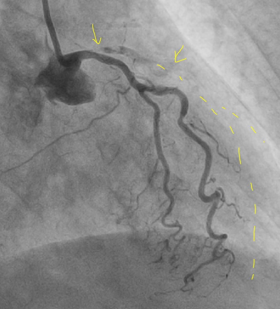 Heart attack at 95 years old - Series Clinical cases, My, The medicine, Heart attack, Age, Hospital, Stent, Video, Soundless, Short videos, Longpost