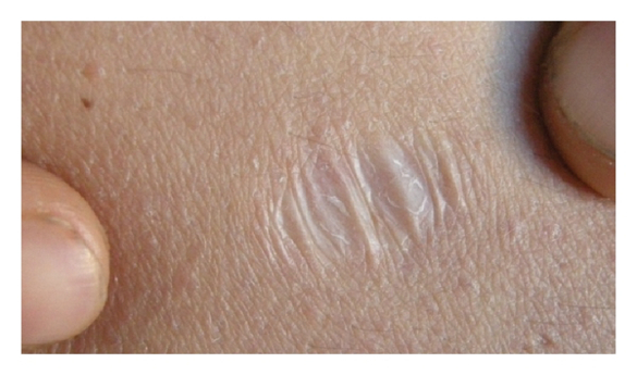 <a href="https://commons.wikimedia.org/wiki/File:Atrophic_scar_of_Ehlers_Danlos_syndrome.jpg?uselang=ru" target="_blank" rel="nofollow noopener">Атрофический рубец. Фото: B. Amichai and A. Zalewska</a>